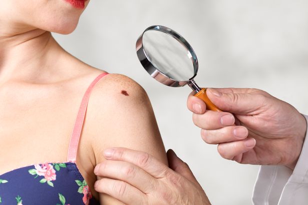Melanoma signs, symptoms, when to see your doctor and the types of mole to look out for